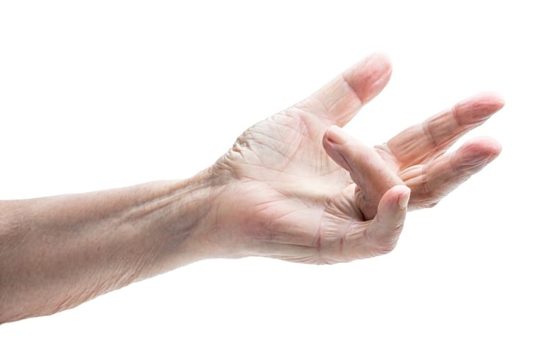 Dupuytrens contracture of the hand and finger