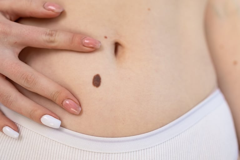 Worried about a mole or mark on the skin?