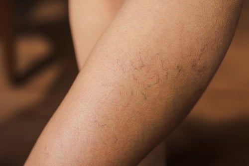 Spider veins on the skin treated with LASER in Gateshead. 