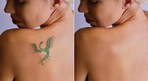 Tattoo Removal - Tattoo Baba - Best Tattoo Studio In Jaipur