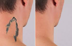 Tattoo Removal - Tattoo Baba - Best Tattoo Studio In Jaipur