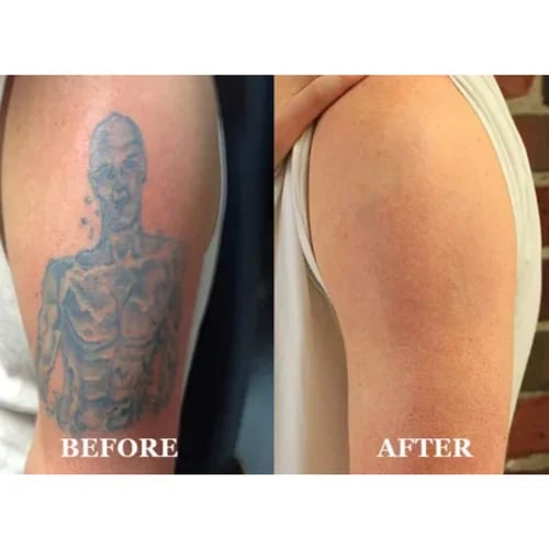 Tattoo Removal - Tattoo Baba - Best Tattoo Studio In Jaipur