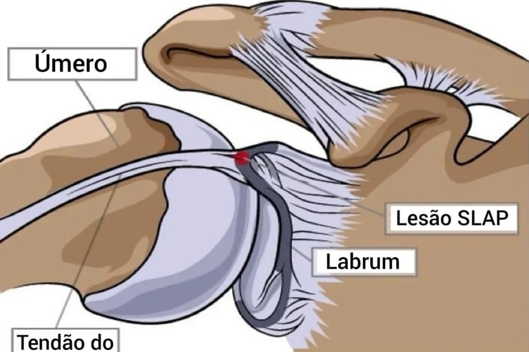articolazione con lesione spalla