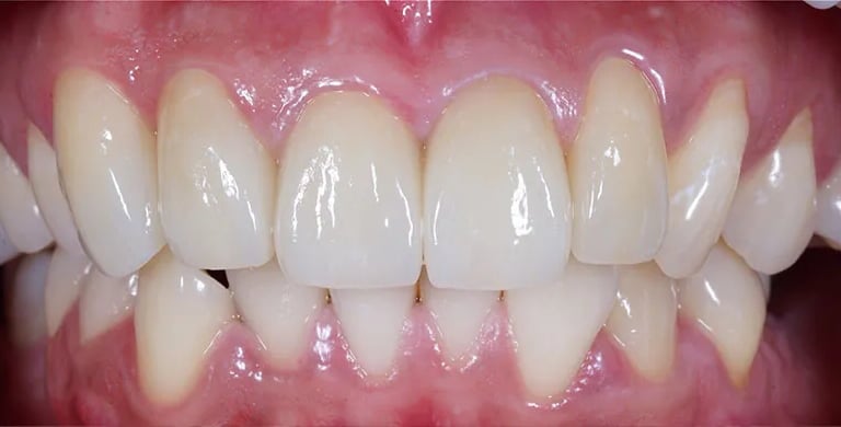 Sorriso in Zirconia