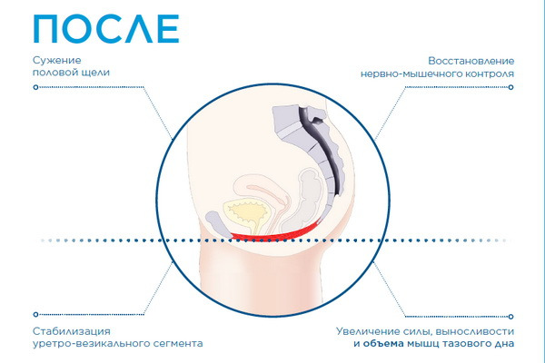 фото після процедури