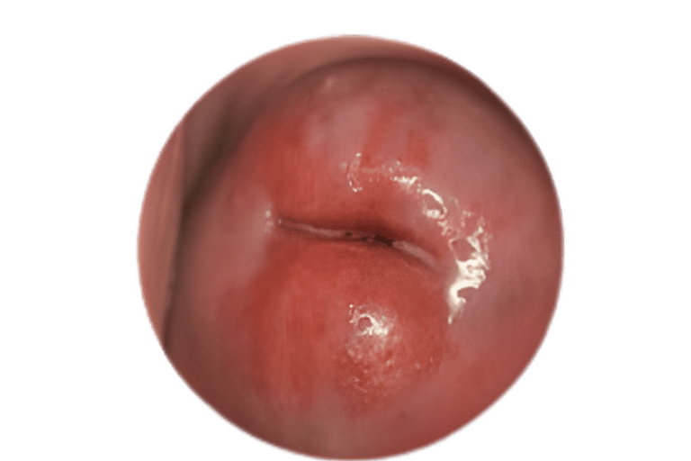 фото Ерозія шийки матки (цервікальна ерозія) на матці