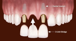 diagram of 3 unit implant bridge