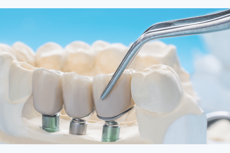 implant crown picture