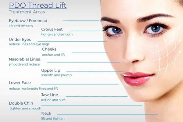 diagram of where PDO threads can be used on the face