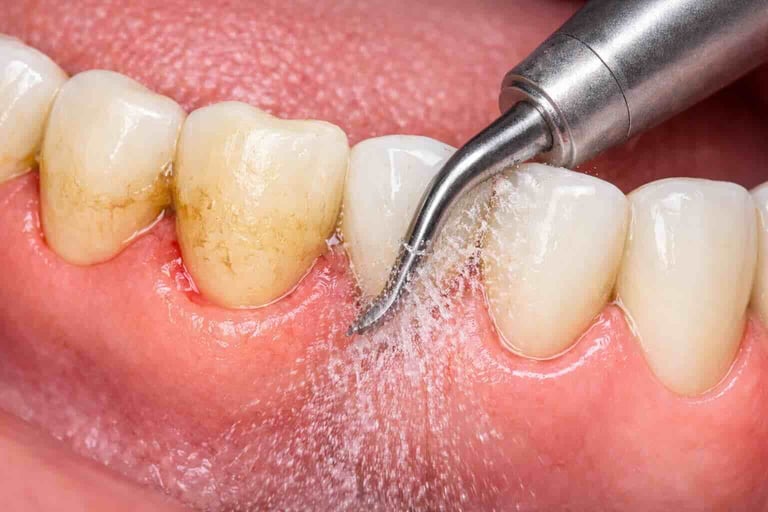 teeth deep cleaning