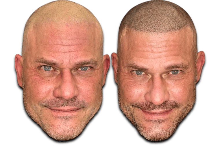 a before/after photo of a man who has received an SMP treatment on his scalp