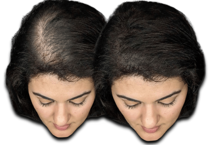 a before/after photo of a woman who has received an SMP treatment on her scalp