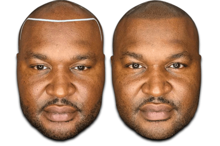 a before/after photo of a man who has received an SMP treatment on his scalp