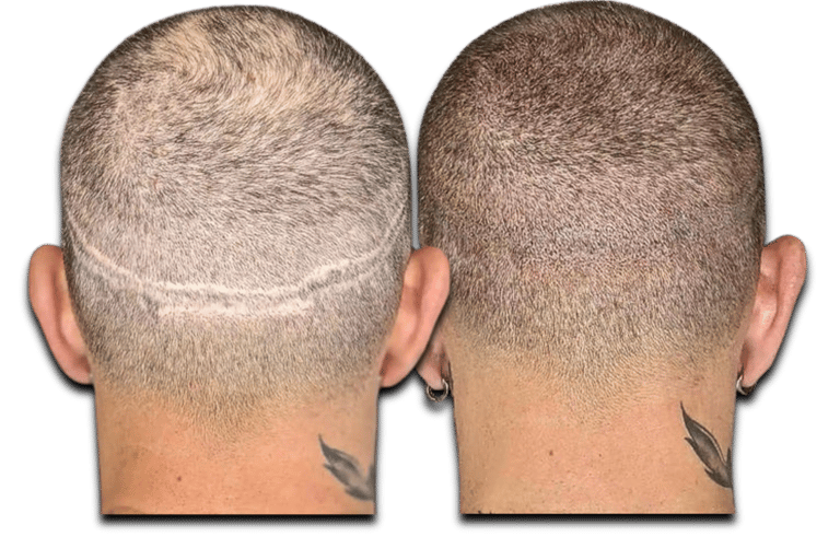 a before/after photo of a man who has received an SMP treatment on his scalp