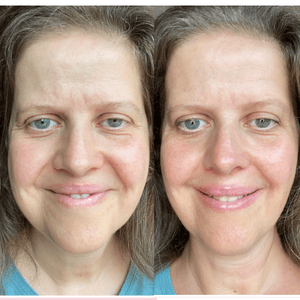 Lifeavntage Collagen Before and After - Woman Face (2)