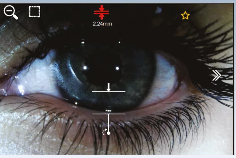 Evaluación lágrima