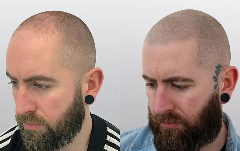 Best Scalp Micropigmentation Toronto_ATRUBARBER