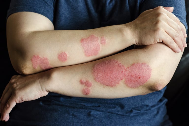 Eczema and Psoriasis Management
