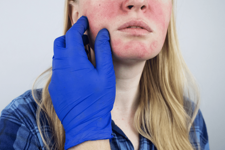 Rosacea Treatment