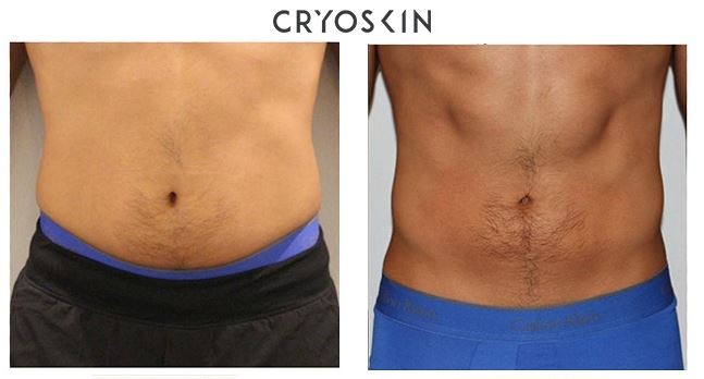 Cryolipolyse avant apres ventre Homme