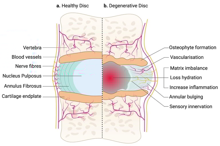 Envelhecimento da coluna vertebral esquematicamente