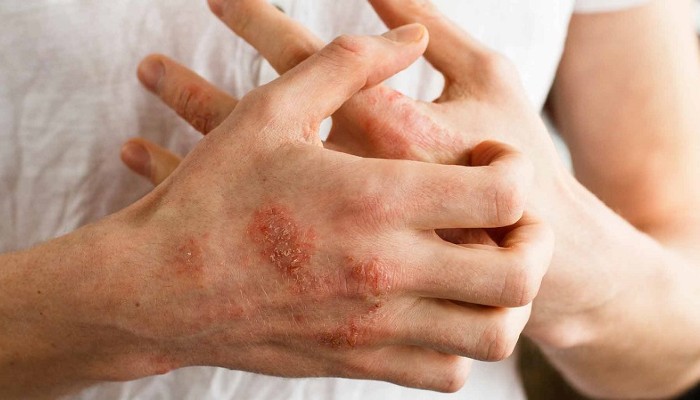 Close-up of a person scratching a red, scaly eczema skin rash on their hand and knuckles.