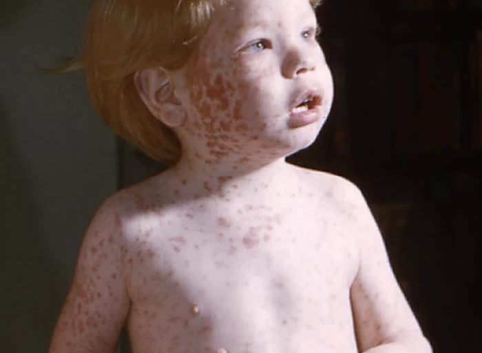rubella