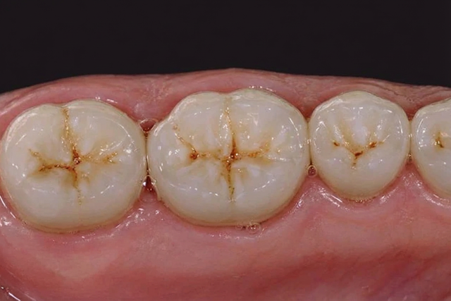 single porcelain fused to metal crowns