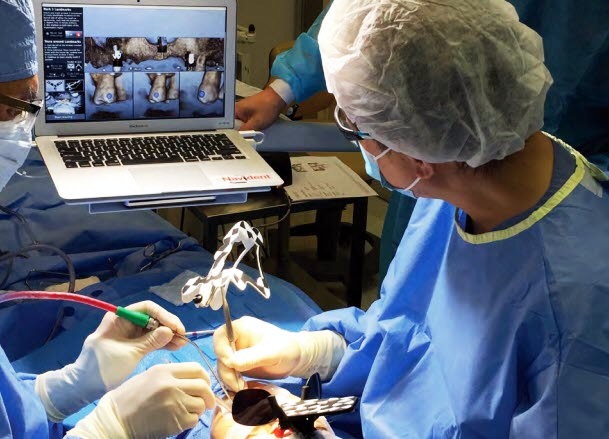 Dental implants guided surgery