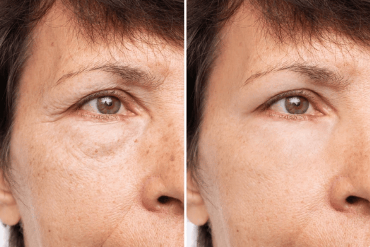 Tratamento de preenchimento de olheiras para um olhar mais jovem e descansado na clínica estética em