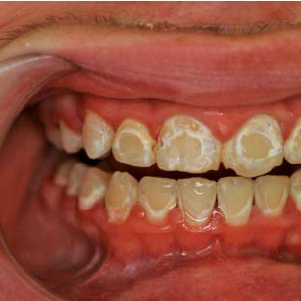 White spot lesions after 14 months of orthodontic treatment with fixed appliances. 
