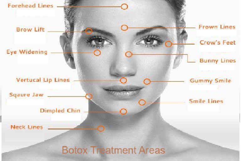 Botox injection sites for wrinkle reduction on a female face.