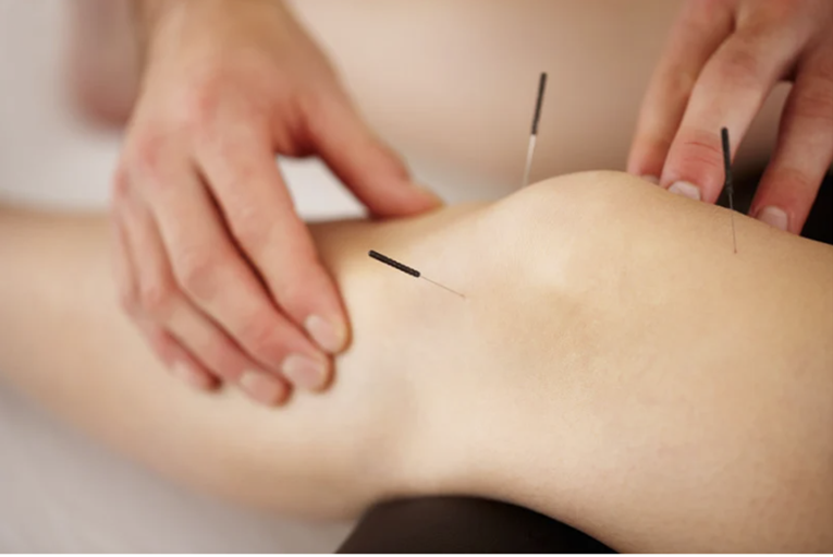Professional practitioner applying acupuncture needles to a patient's knee for pain relief therapy.