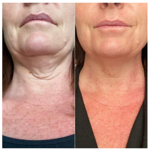 Lifevantage Collagen Before and After Results - woman neck