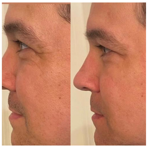 Lifevantage Collagen Before and After Results - man face (2)