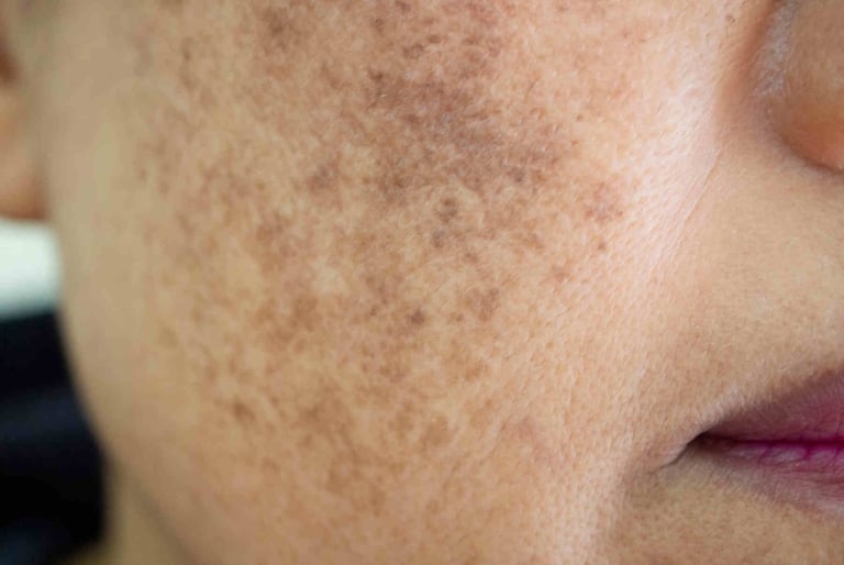melasma face