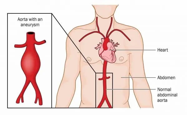 Aorta