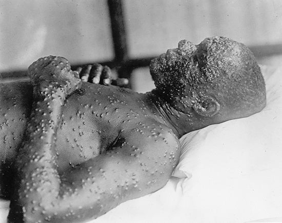 Smallpox