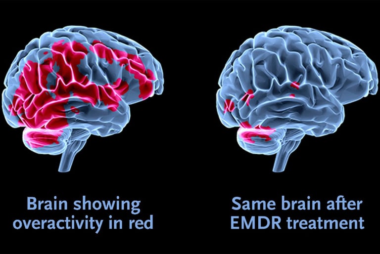 EMDR does not re-traumatise like exposure therapy. The sufferer does not have to re-live the events.