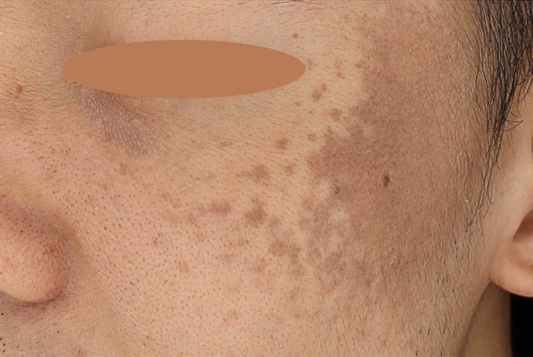 nevus of ota birthmark singapore