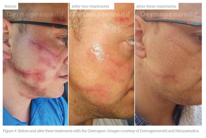 a man before and after dermapen 4