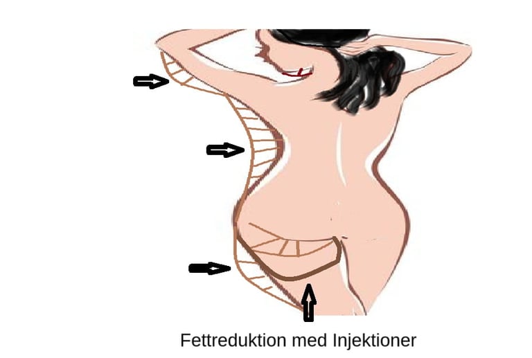 Illustration av kropp som visar zoner för fettreduktion och behandling av lokala fettdepåer