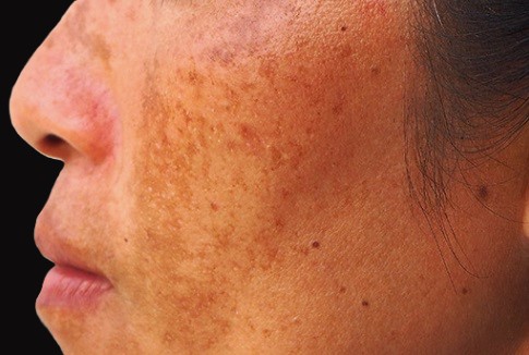 Melasma treatment at Ariana Esthetic Edmonton
