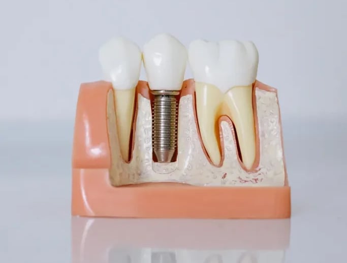 Implantes de carga inmediata en Sevilla