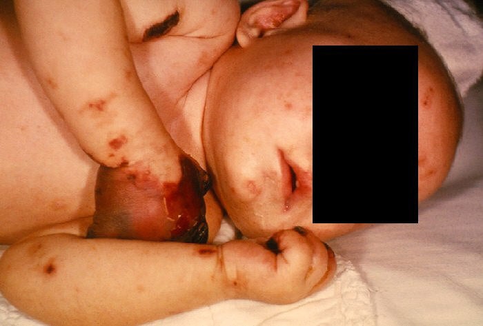 horrid meningococcal disease