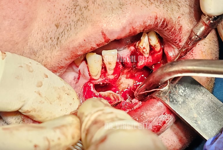 Chistectomie mandibulara