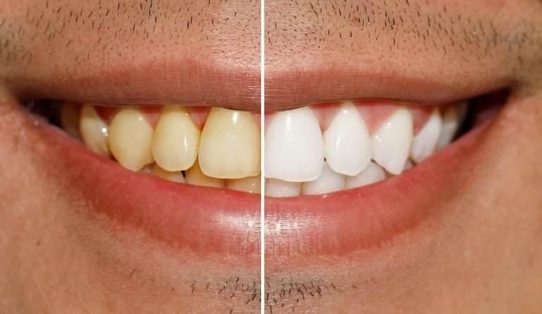 Before and after professional teeth whitening comparison showing yellow stains vs bright white smile.