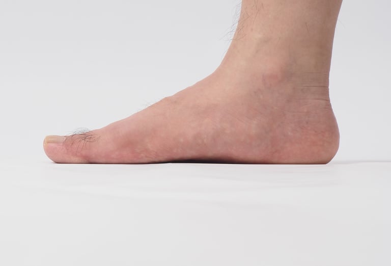 flat feet 