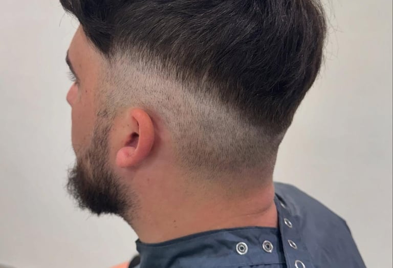 hair Transplant in hull non surgical