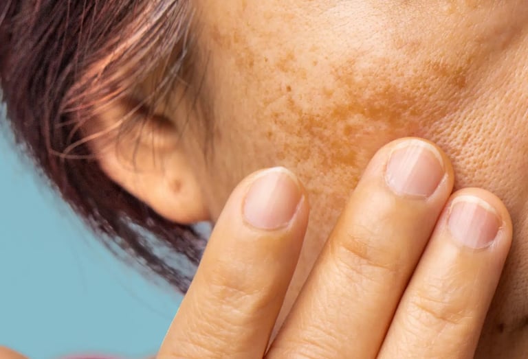 cabinet perma medical : mélasma et tâches pigmentaires